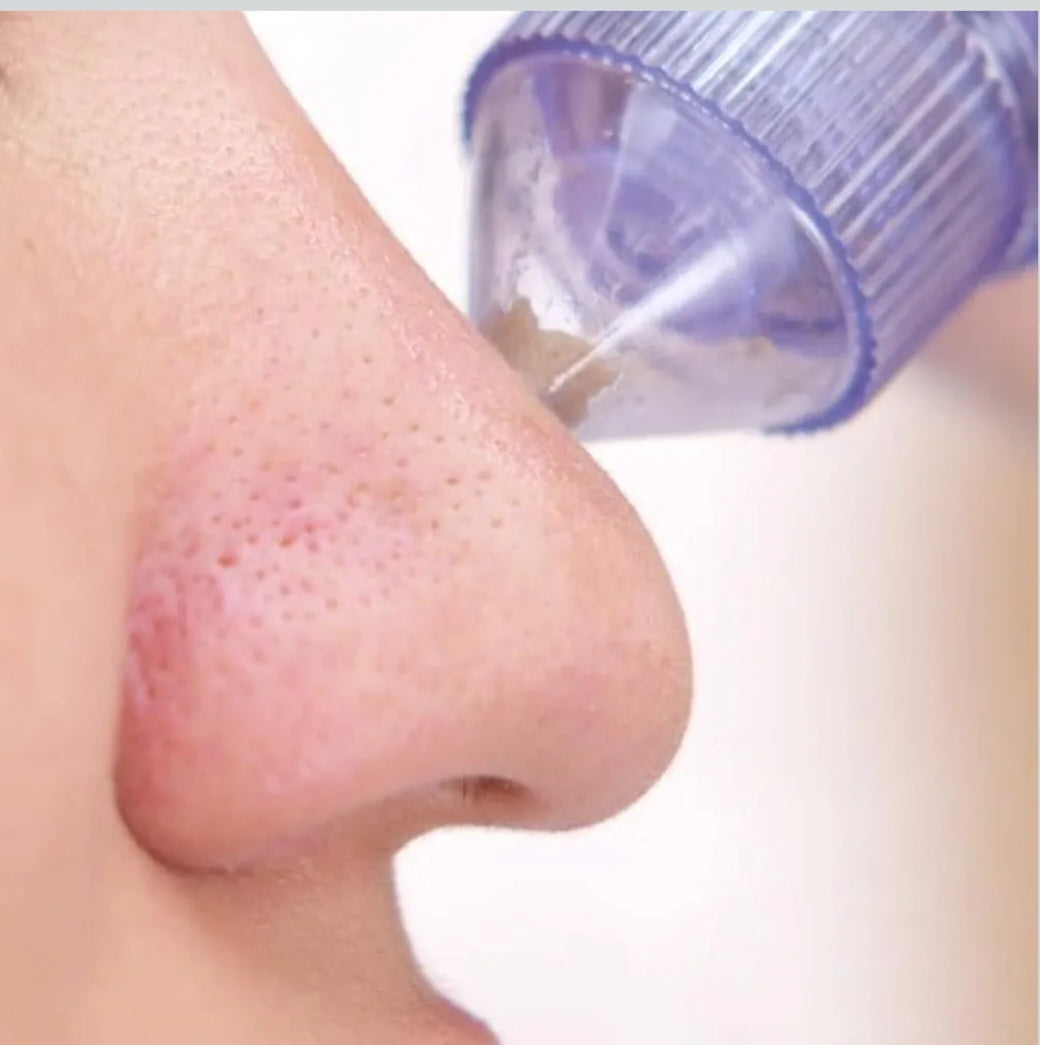 🧖‍♀️ Electric Blackhead Remover & Pore Vacuum Cleaner ✨